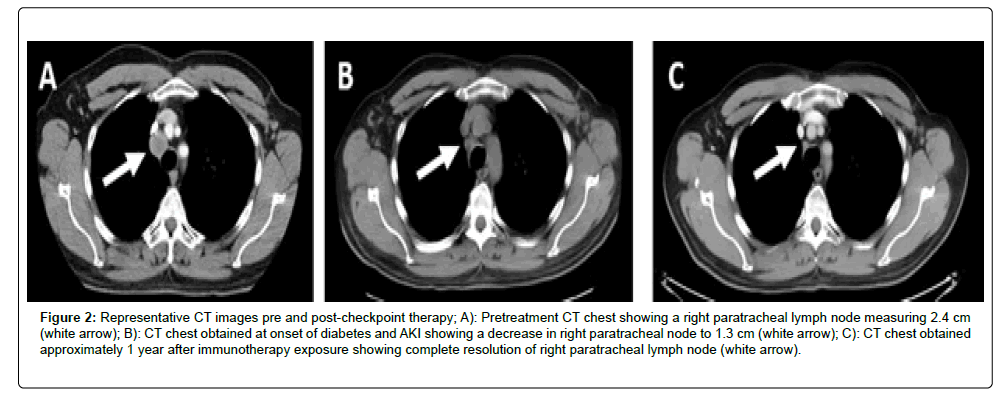 Clinical-Oncology-paratracheal-lymph