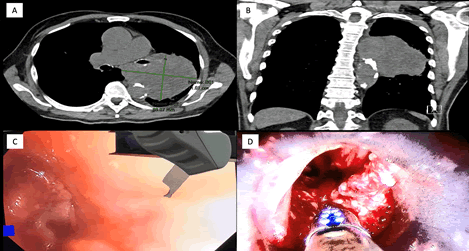 Journal-Pulmonary-Medicine-Coronal