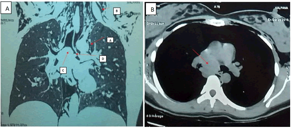 Journal-Pulmonary-Medicine-Coronal