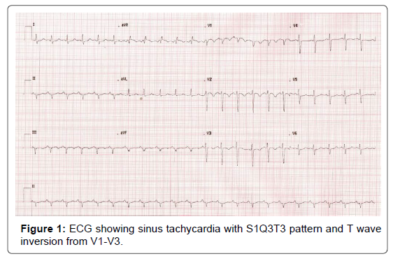 Acute Pulmonary EmbolismTale Tell Signs SciTechnol Acute Pulmonary EmbolismTale Tell Signs SciTechnol