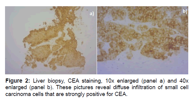 clinical-oncology-diffuse-infiltratio