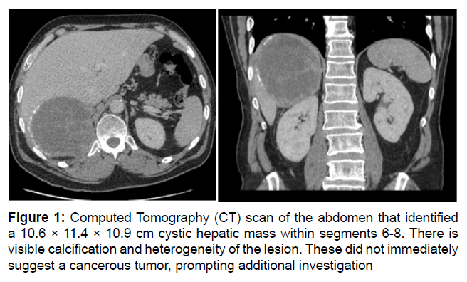 clinical-oncology-hepatic-mass