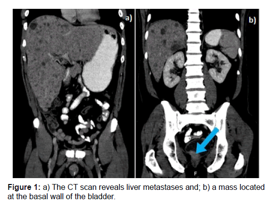 clinical-oncology-liver-metastase