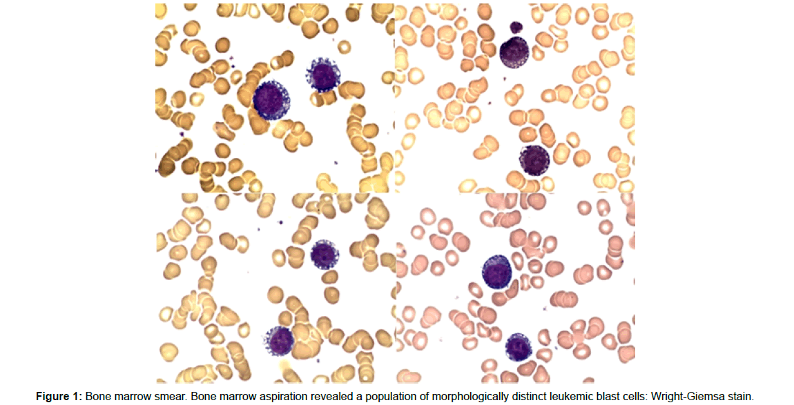 clinical-oncology-marrow-aspiration