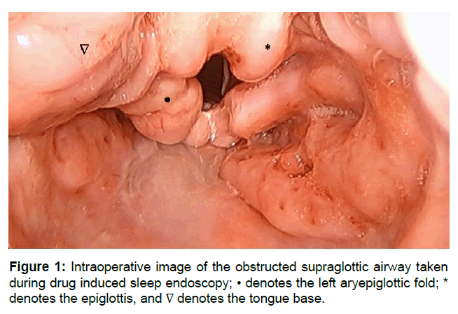 clinical-oncology-supraglottic-airway