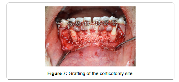 dental-health-current-research-Grafting