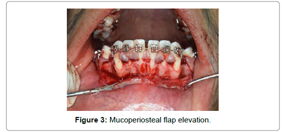dental-health-current-research-Mucoperiosteal