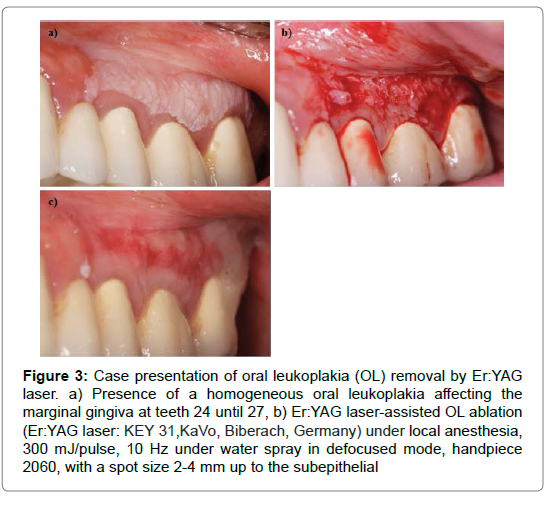 dental-health-current-research-leukoplakia