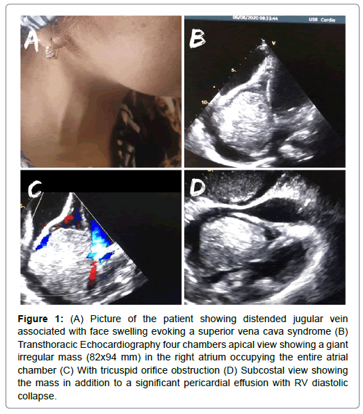 international-journal-of-cardiovascular-research-jugular-vein