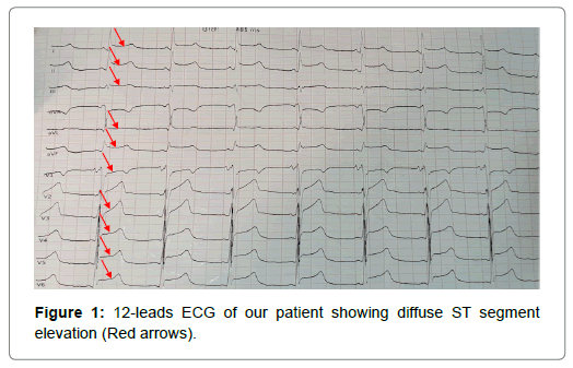 international-journal-of-cardiovascular-research-segment-elevation