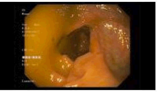 research-reports-colonoscopy