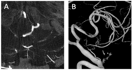 spine-neurosurgery-contrast