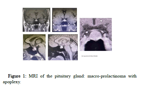 A Pituitary Macroadenoma Apoplexy SciTechnol A Pituitary Macroadenoma Apoplexy SciTechnol
