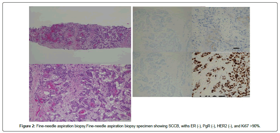 clinical-oncology-Fine-needle clinical-oncology-Fine-needle