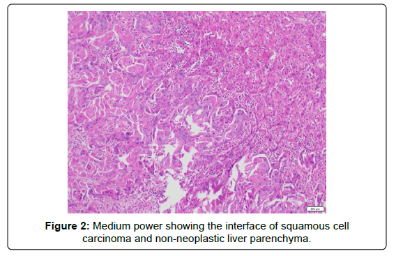 clinical-oncology-carcinoma