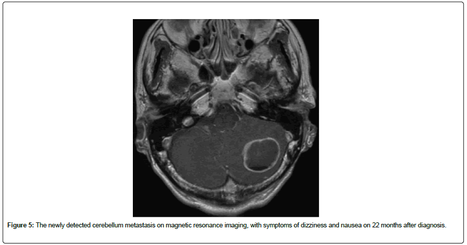 clinical-oncology-cerebellum