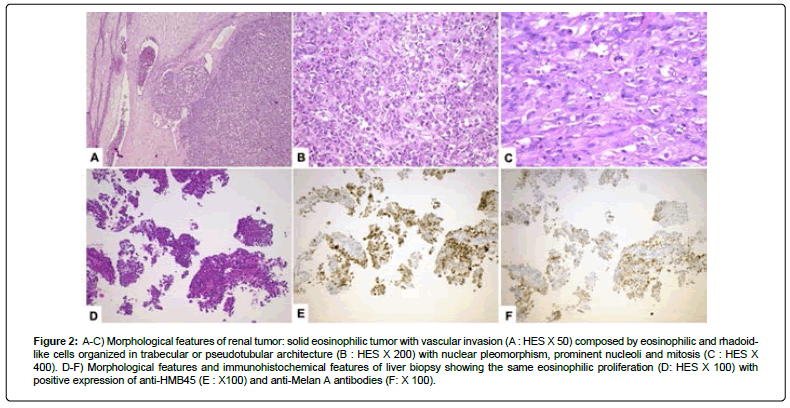 clinical-oncology-eosinophilic