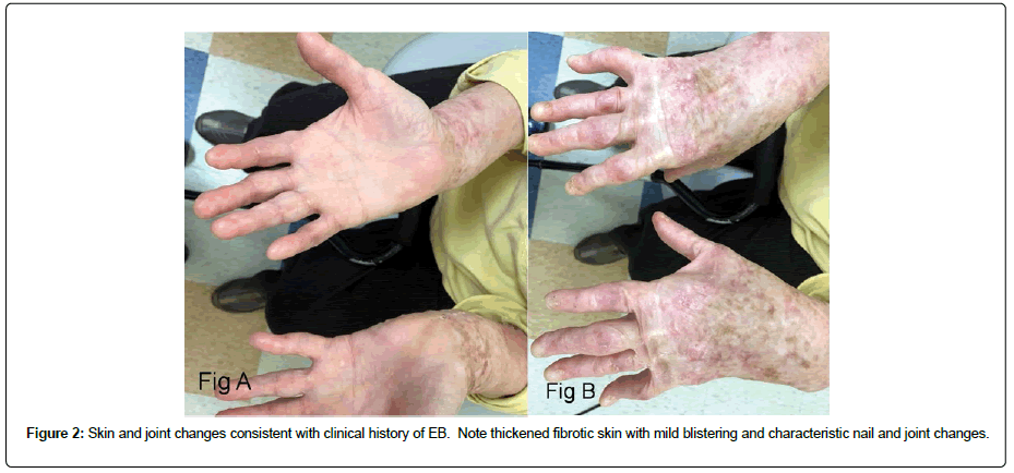 clinical-oncology-fibrotic clinical-oncology-fibrotic