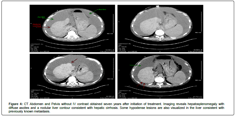 clinical-oncology-hypodense