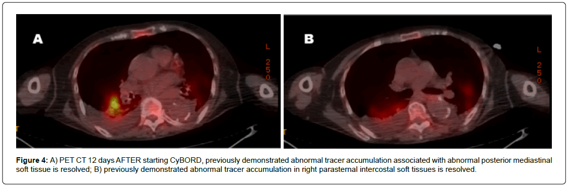 clinical-oncology-intercostal