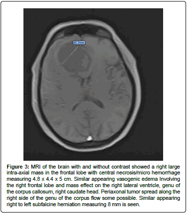 clinical-oncology-intra-axial