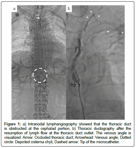 clinical-oncology-lymphangiography