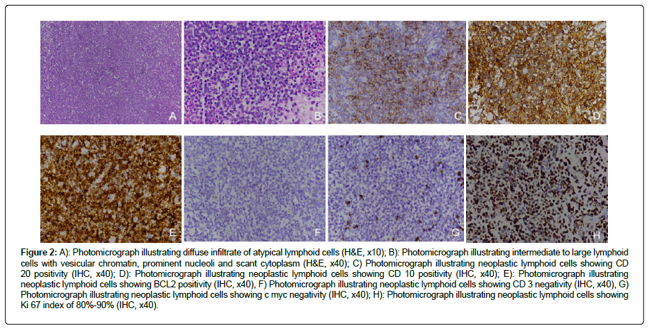 clinical-oncology-lymphoid