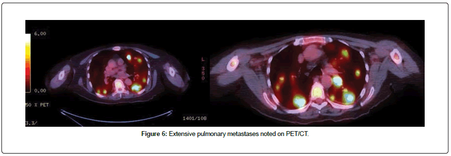 clinical-oncology-metastases