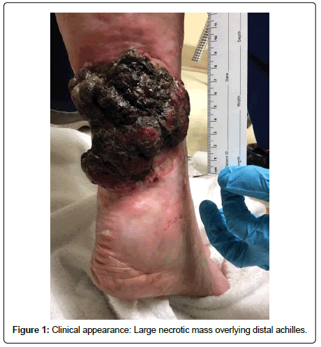 clinical-oncology-necrotic