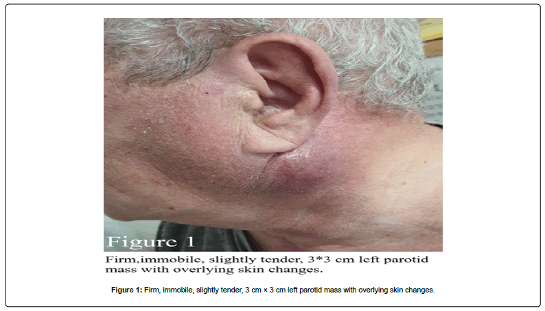 clinical-oncology-parotid