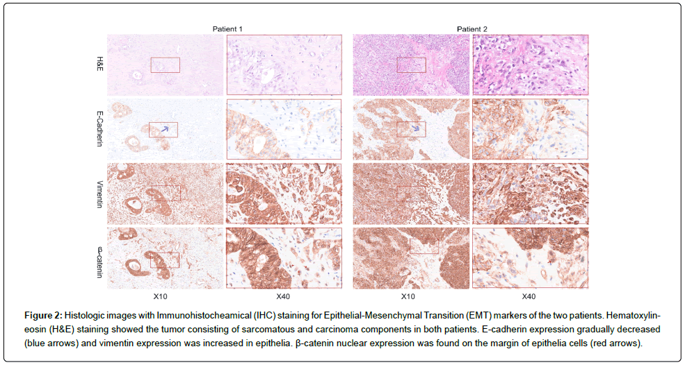 clinical-oncology-sarcomatous