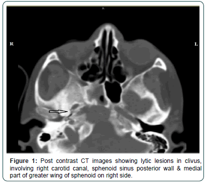 clinical-oncology-sphenoid