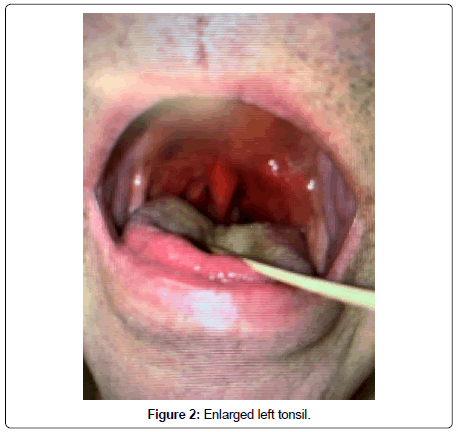 clinical-oncology-tonsil