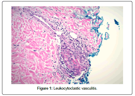 clinical-oncology-vasculitis