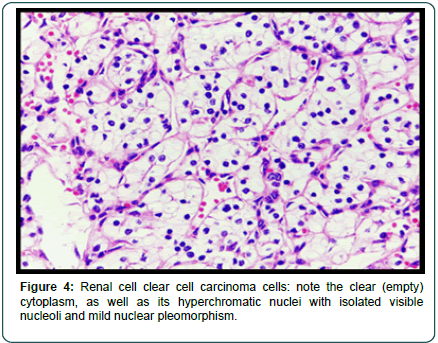 cocr-carcinoma