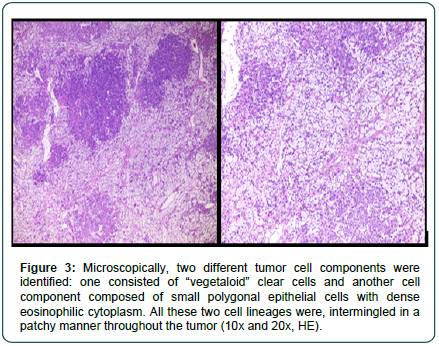 cocr-eosinophilic