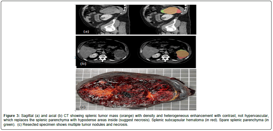cocr-splenic cocr-splenic