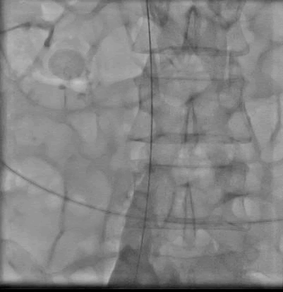 international-journal-catheter international-journal-catheter