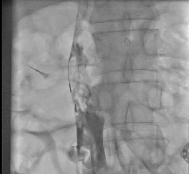 international-journal-thrombus