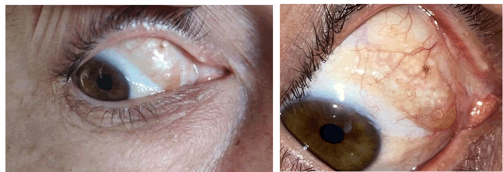 ophthalmic-pathology-lesion