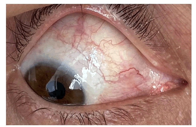 ophthalmic-pathology-scar