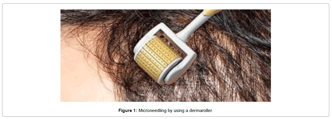 regenerative-medicine-microneedling