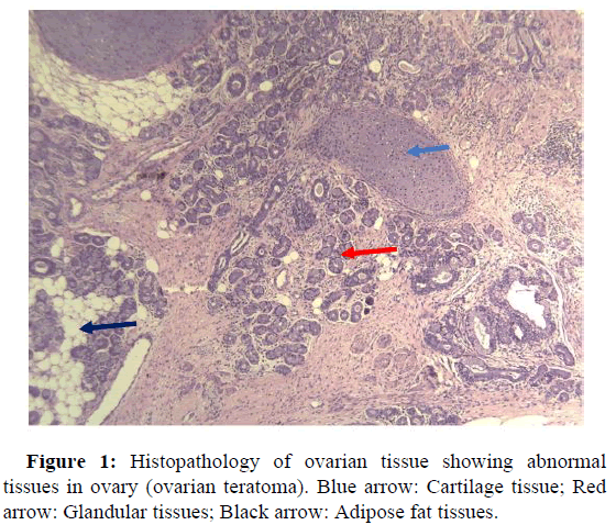 JNSCR-ovarian