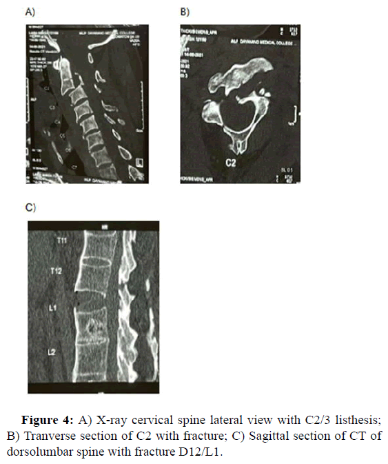 JSNS-cervical
