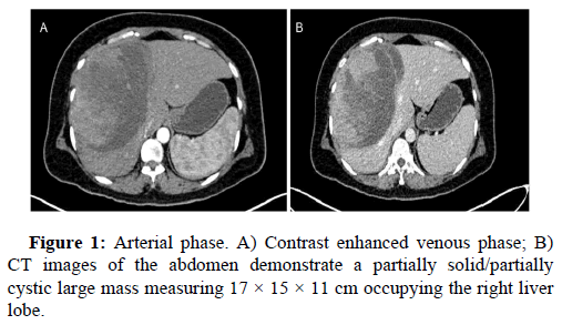 Liver-Transplantation