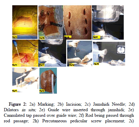 Spine-Neurosurgery-Jamshidi