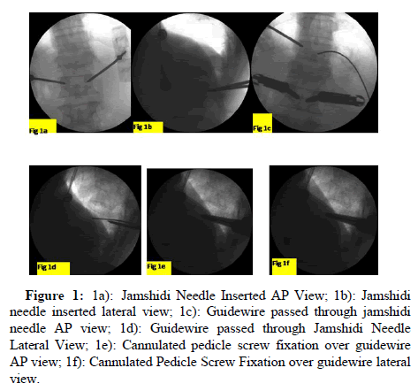 Spine-Neurosurgery-Needle