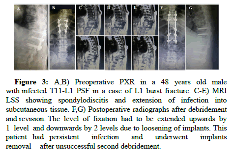 Spine-Neurosurgery-Postoperative Spine-Neurosurgery-Postoperative
