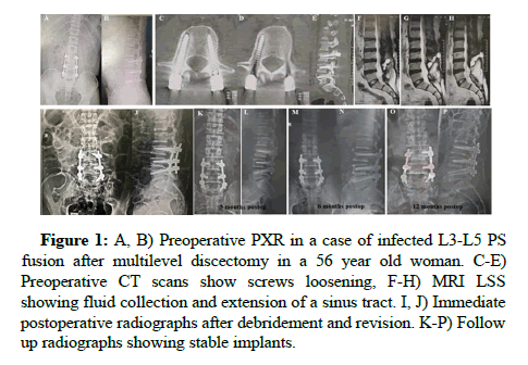 Spine-Neurosurgery-Preoperative Spine-Neurosurgery-Preoperative