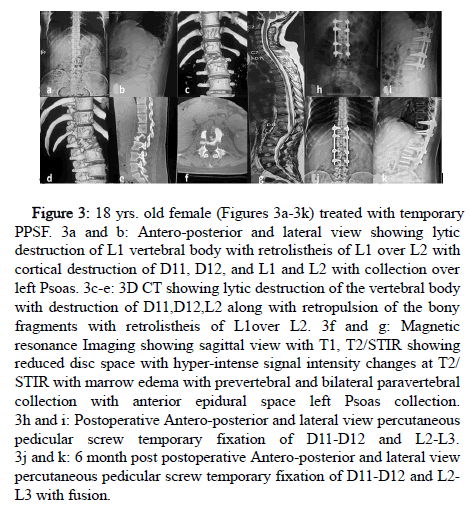 Spine-Neurosurgery-pedicular